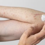 От чего помогает Фуцис и при каких инфекциях его назначают